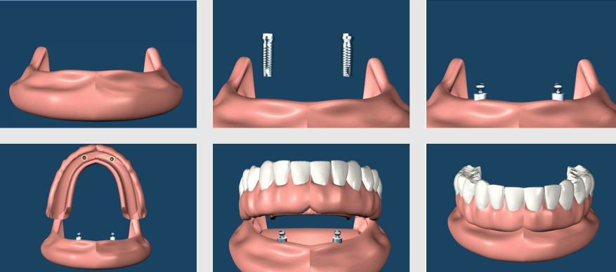 Implant Supported Removable Dentures