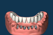 Upper/Lower Jaw Implants