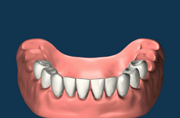 Upper/Lower Jaw Implants